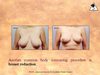 Dr. Kris Reddy Reviews Breast Reduction
