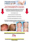 Psoriasis Light Treatment - Psoriasis Natural Treatment - Psoriasis Vulgaris