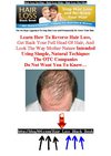 Hair Loss In Men - Hair Loss Help - Hair Loss For Men