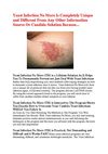 Signs of yeast infection - Cure for yeast infection - Yeast infection men