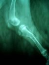 FIJADORES EXTERNOS FRACTURA TIBIA