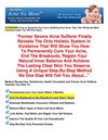 teenage acne treatment - acne treatment at home - natural cures for acne