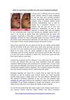 best home remedies for acne scars