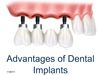 Advantages of Dental Implants