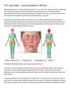 The Lupus Rash - Lupus Symptoms In Women