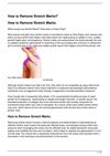 How to Remove Stretch Marks?