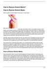 How to Remove Stretch Marks?