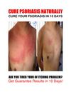 Cure Psoriasis in 10 Days!