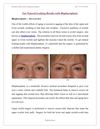 Get Natural Looking Results with Blepharoplasty