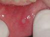 Herpes En La Boca