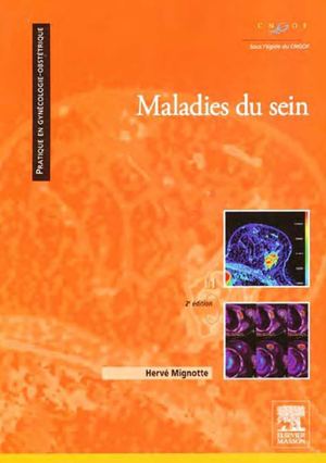 calcifications du sein